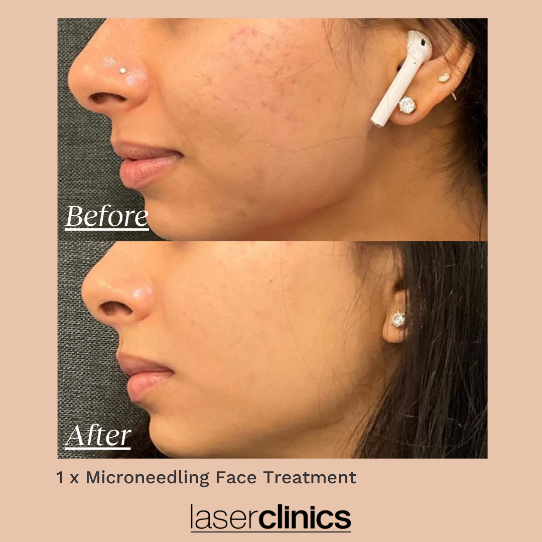 Minimise stretch marks with microneedling - Lasermed: Laser Clinic & facial  rejuvenation