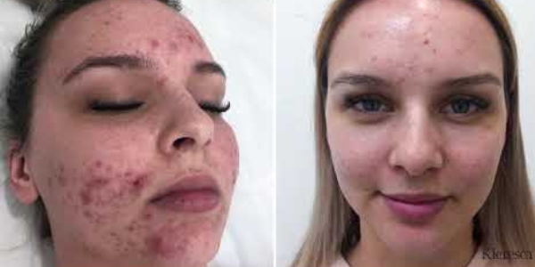 Kleresca® Acne - the revolutionary skin treatment for acne and